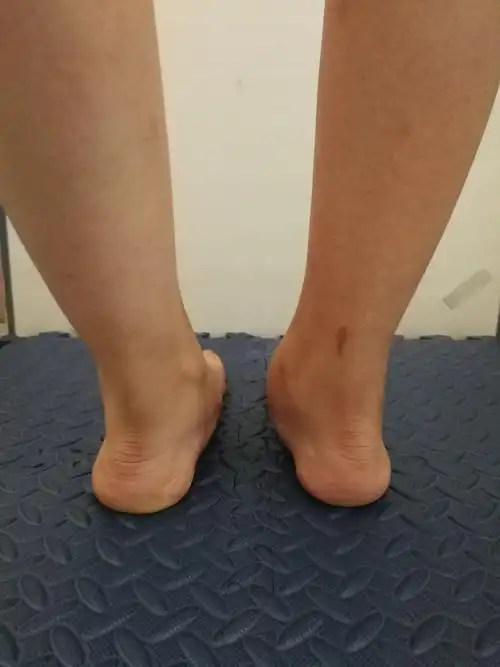 足踝疼痛小心副舟骨综合征!