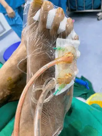 优质医疗服务系列报道 | 反复创面破溃竟有截肢风险,mdt模式让"糖足"