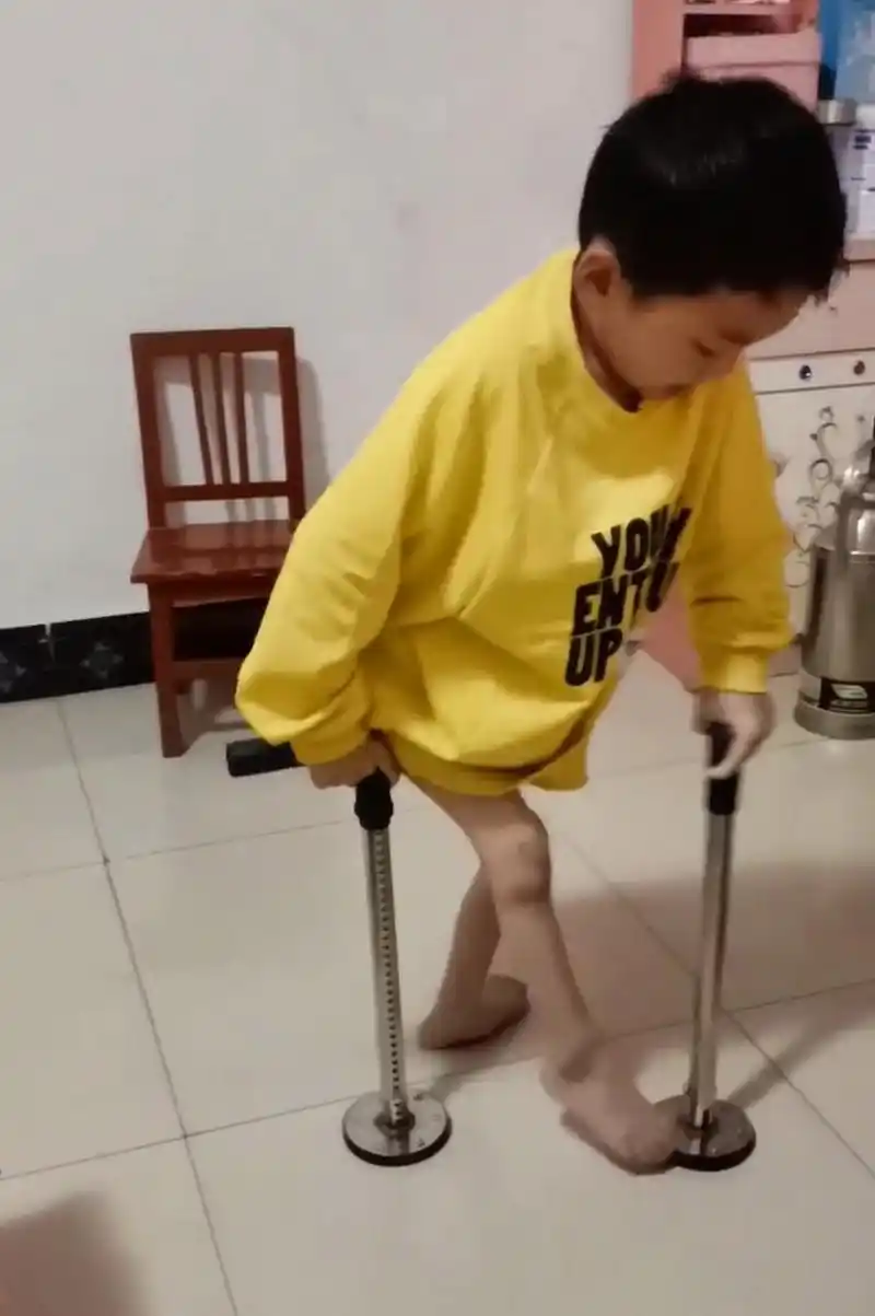 他只有10来岁,却身患先天性脊柱裂,无法站立行走,真的难以想象,这10
