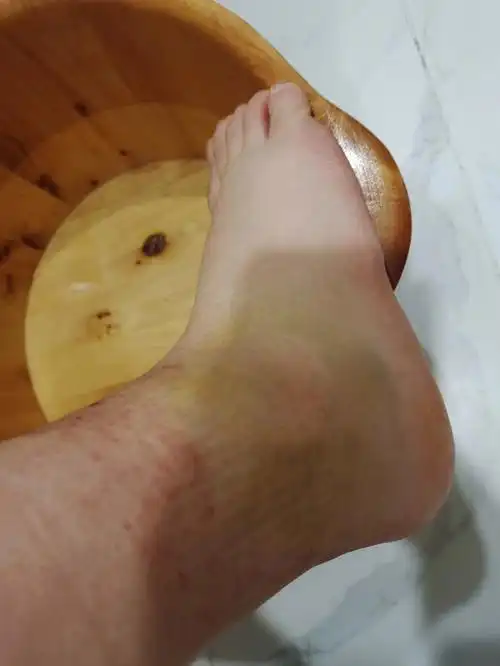 三次脚裸韧带拉伤总结的误区经验