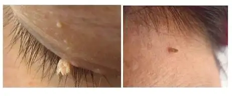 眼皮上长了一小搓"金针菇",而且会传染?!|治疗|丝状疣|出血|皮损_网易