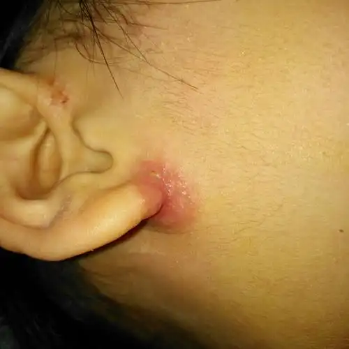 孩子耳根反反复复好不了,怎么办,跪求良方.