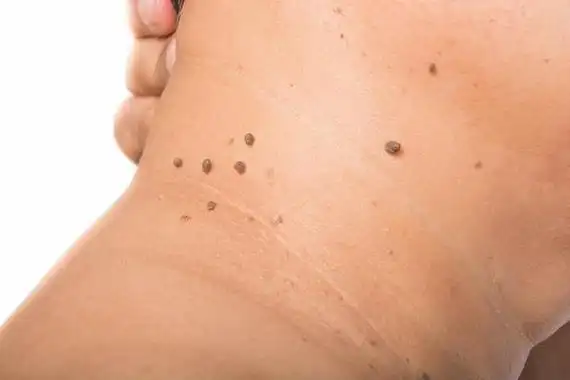 看医生怎么说|软纤维瘤|皮肤病|丝状疣|扁平疣|皮肤|治疗|-健康界