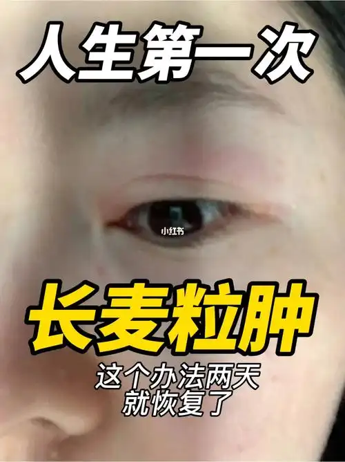 用眼过度才会长麦粒肿吧这方法挺有用啊