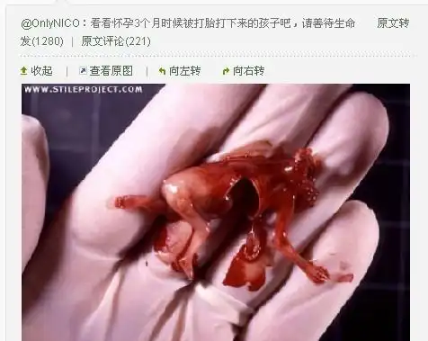 怀孕100天,引产是什么样子的?