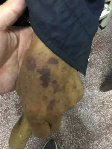 臀部皮肤现大片瘀斑,这是「屁股中毒了」?