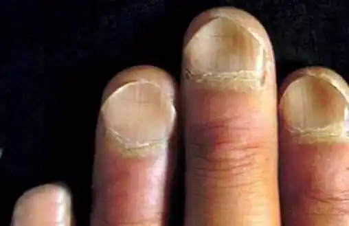 从指甲看出的问题,所有的人都应该自检一下