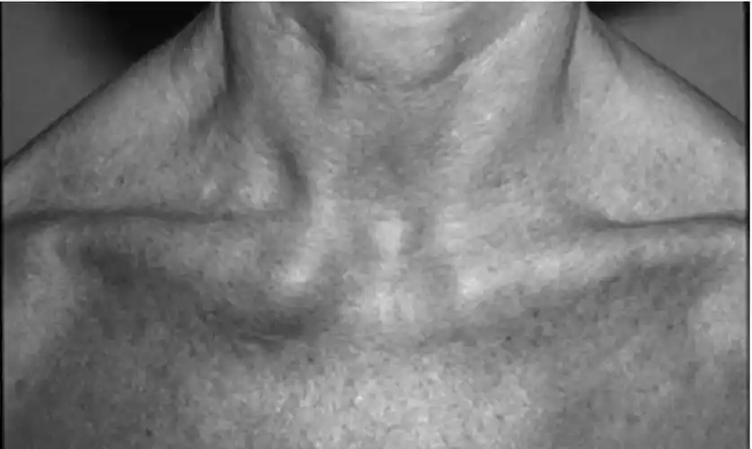 锁骨"凸起"隐隐作痛,当心这个小关节在作祟_身材_患者_包括