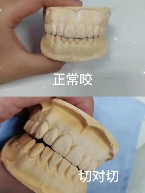 不要小看牙齿正对正咬的危害