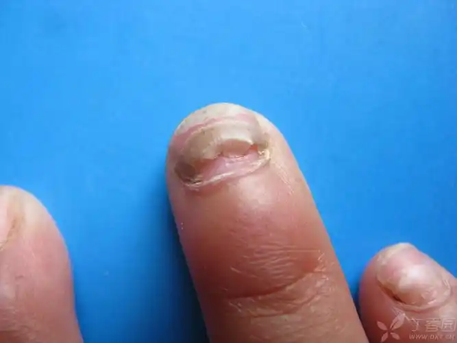 【病例讨论】又一儿童甲分离 [病例帖]