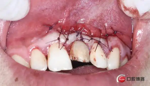 全身抗炎治疗3-5日;5:放置cgf;骨板回填;缝合关闭创口;4:剥离摘除囊肿