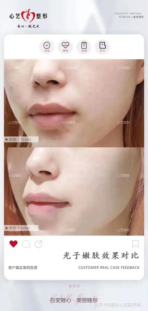 光子嫩肤效果对比