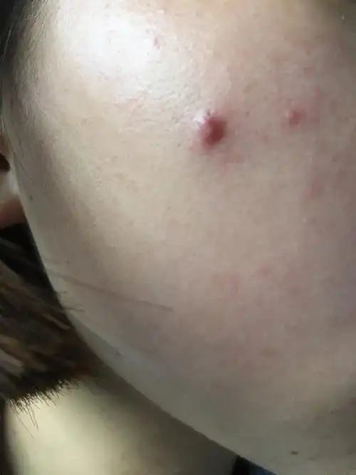长了一个大痘痘,应该怎么消除啊,有点疼,好几天了一直没有冒白头