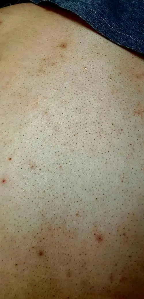 背部毛孔粗大毳毛该如何是好