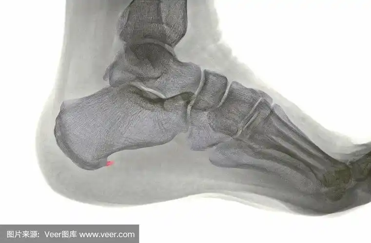 人跟骨刺的x光片