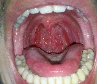 疱疹性咽喉炎,几年了一直反反复复求根治良方,本人今年二十七岁