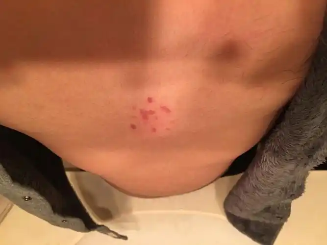 胸前正中央起了一堆小红斑,不疼不痒…这是什么东西啊