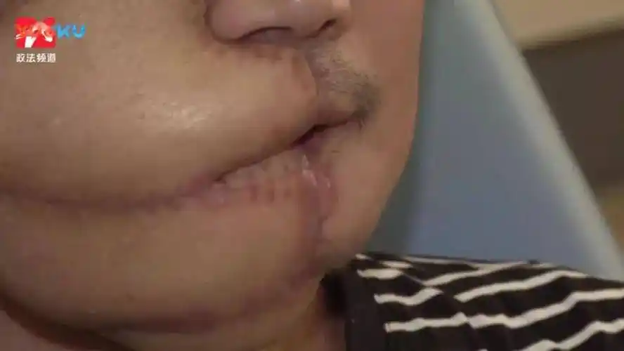 手术时,有时需要打开整个口腔,然后割掉舌头,切去牙床,再进行缝合.