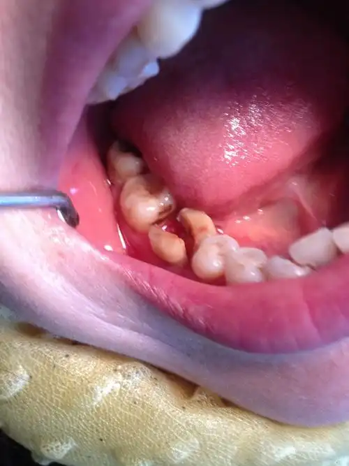 牙隐裂导致牙纵裂后修复成功一例