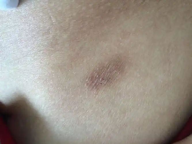 大腿外侧皮肤上长有黑斑像癣一样的东西,请专家确诊