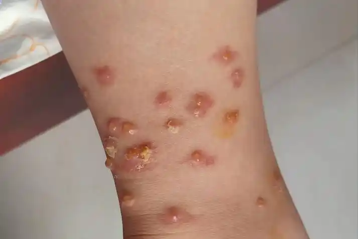 水疱型丘疹性荨麻疹图