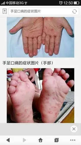 手足口症状的图片