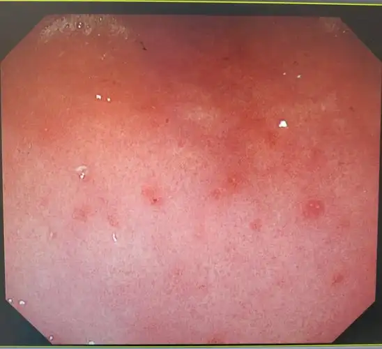 解读胃镜报告——糜烂,溃疡和肠化_胃镜_胃镜相关疾病 - 好大夫在线