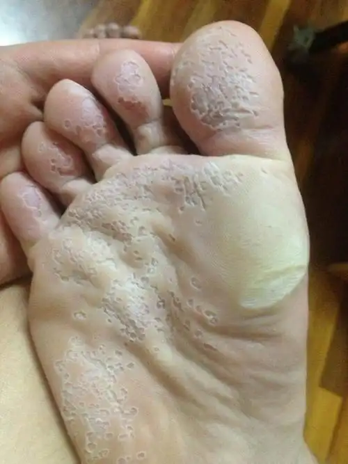 脚底脱皮严重,像是真菌引起的,帮忙看看这个该怎么治疗