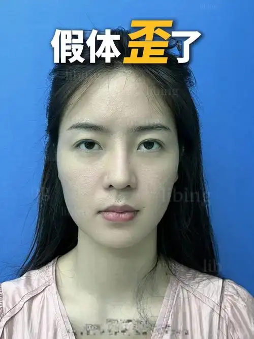 鼻子假体歪斜怎么办?看看这个视频你就知道了!