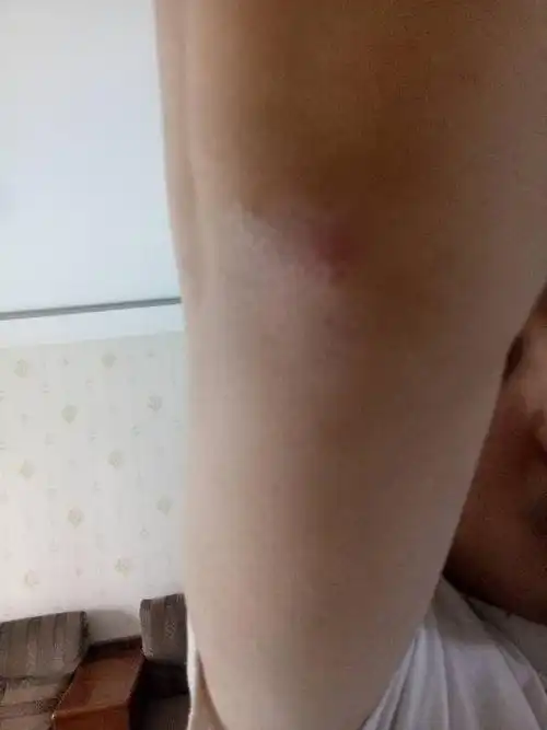 膝盖,胳膊肘长了一块红色的,一按就疼,腿的快好了,胳膊的还没好,是