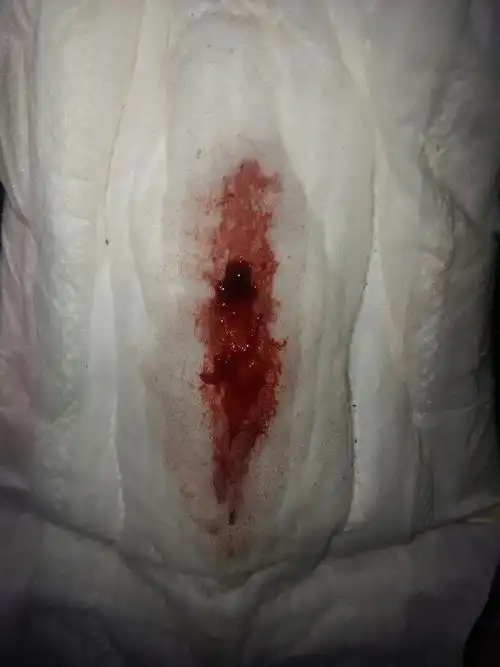 经血像鼻涕一样拉很长不会断,正常么?