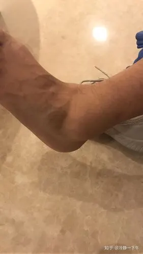 脚踝扭伤者的恢复之路1