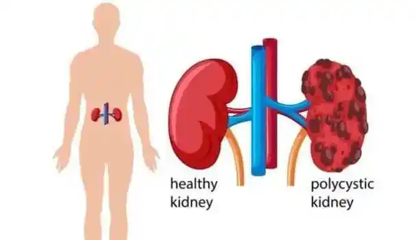 肾萎缩一定会发生肾衰竭?一种情况,有逆转的机会!