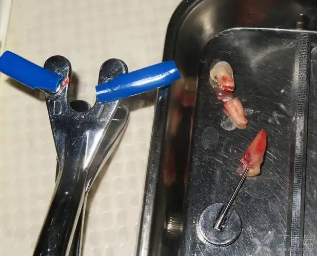 我临床发明的微创拔牙钳在前牙即拔即种的应用 [病例帖]