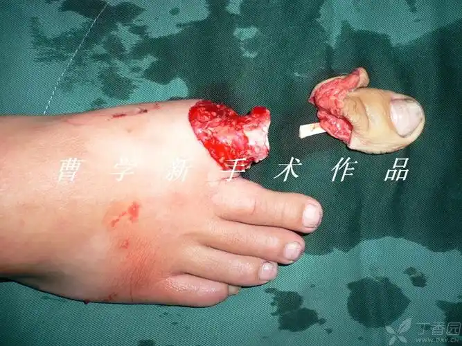 足拇趾离断再植几例