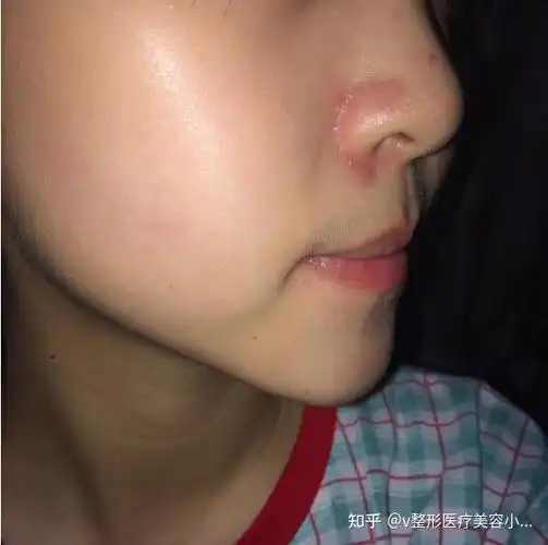 脂溢性皮炎你中招了吗?