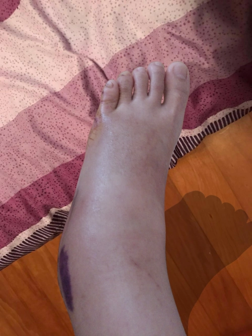 请大神帮我把下面的图ps,就是把受伤的脚抠出来放入第三张图中,最好看