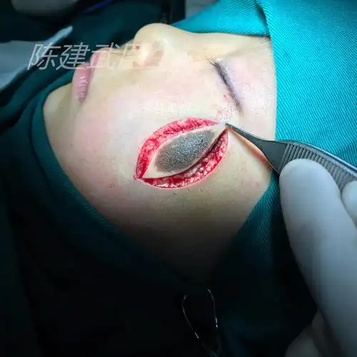 图解黑痣切除手术过程 - 好大夫在线