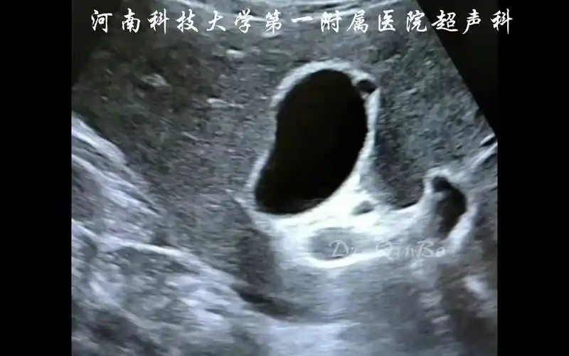 罗阿氏窦 胆囊囊肿