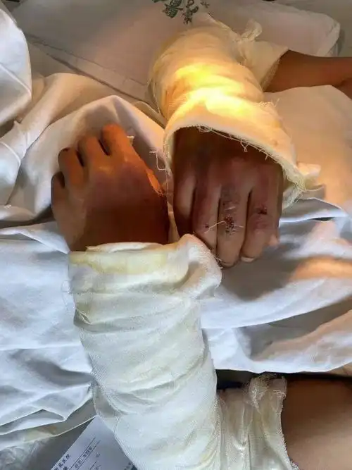 附属医院,火灾伤者之一的阿来,虚弱地躺在病床上,手臂缠上厚厚的纱布