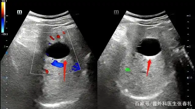 很多人体检会发现有肝囊肿,肝囊肿到底是什么?应该如何判断?
