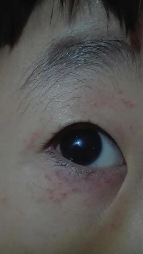 今天刚发现孩子的两只眼睛上下眼皮都有这个红色血点,也不知道怎么