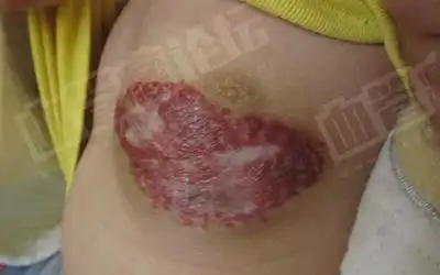 董*琳-胸部-混合型血管瘤