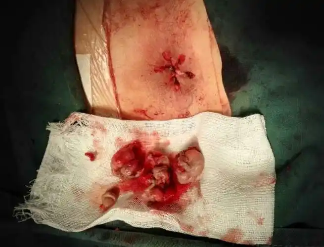 血栓性外痔图片 (60)