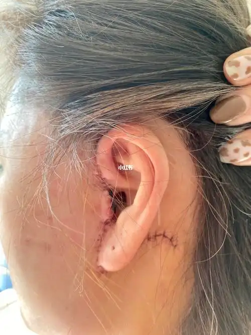 拉皮手术第五天洗头发