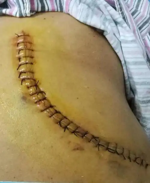 完全腹腔镜下外伤性脾破裂切除术在河南大学附属颐和医院成功开展