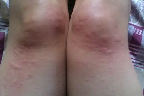 我在惠州最近我的膝盖还有胳膊肘有两次起这样的疙瘩了,一次是下雨天