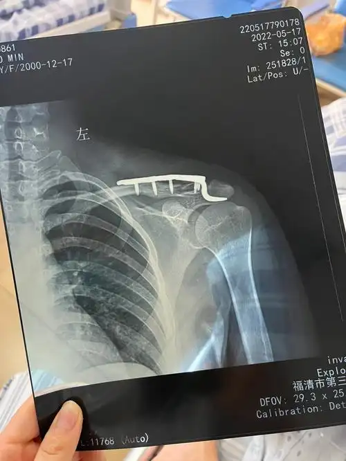 左锁骨肩峰端骨折