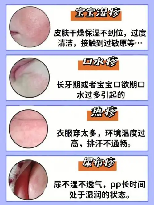 宝宝湿疹,口水疹,尿布疹,热疹等等都是小月龄宝宝经常会遇到的皮肤