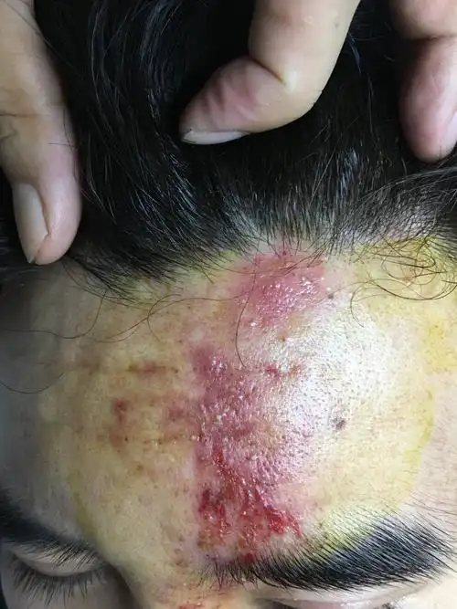 面部玻尿酸填充栓塞门诊所见 - 好大夫在线